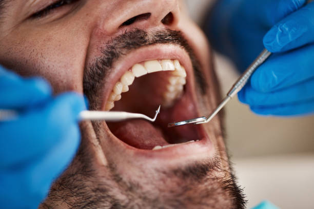 Best Emergency Wisdom Tooth Extraction in Darlington, SC